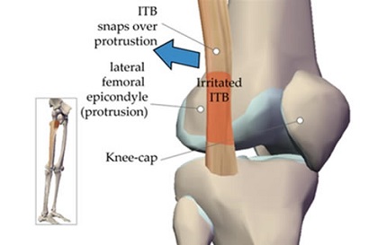 Treatment for torn ligaments or tendons knee acl mcl diagram