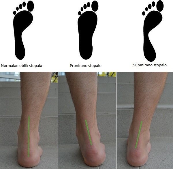 liječenje artroze gležnja u stopalu