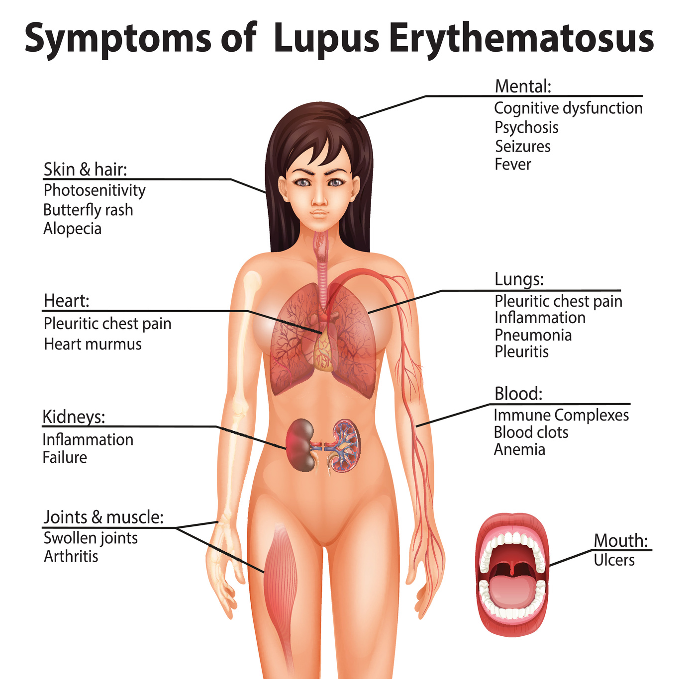 lupus