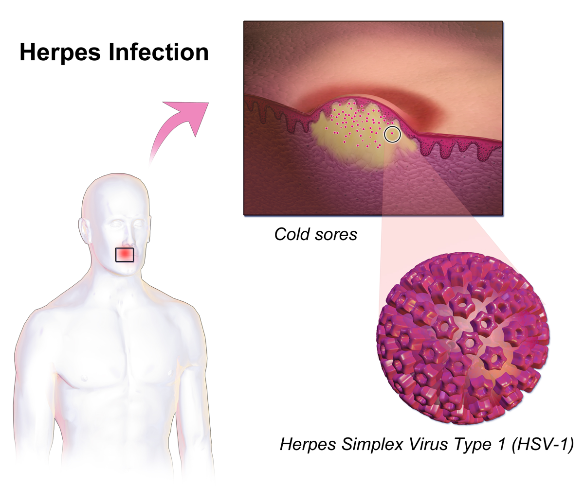 herpes