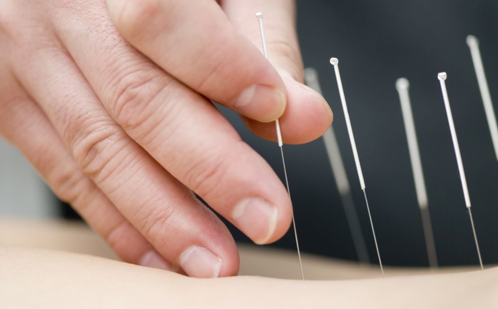 acupuncture