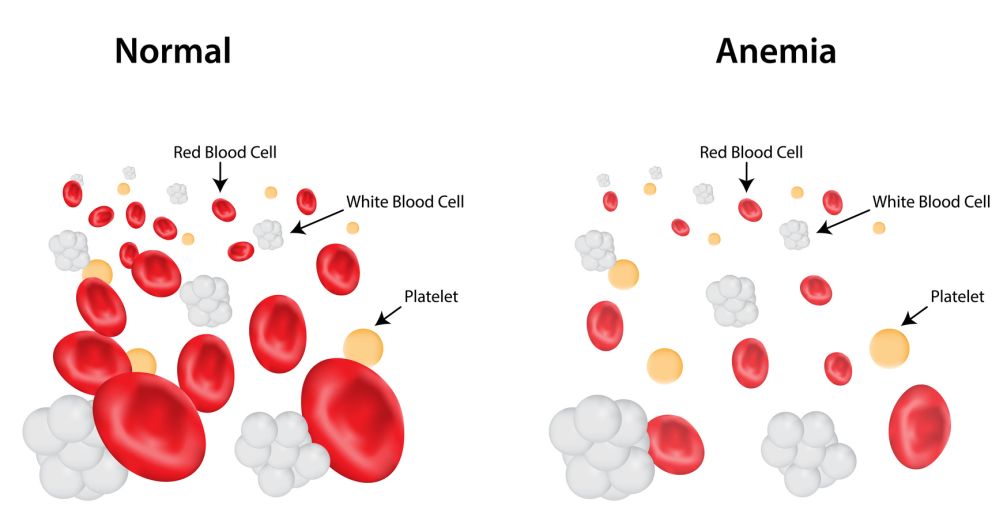 anemija