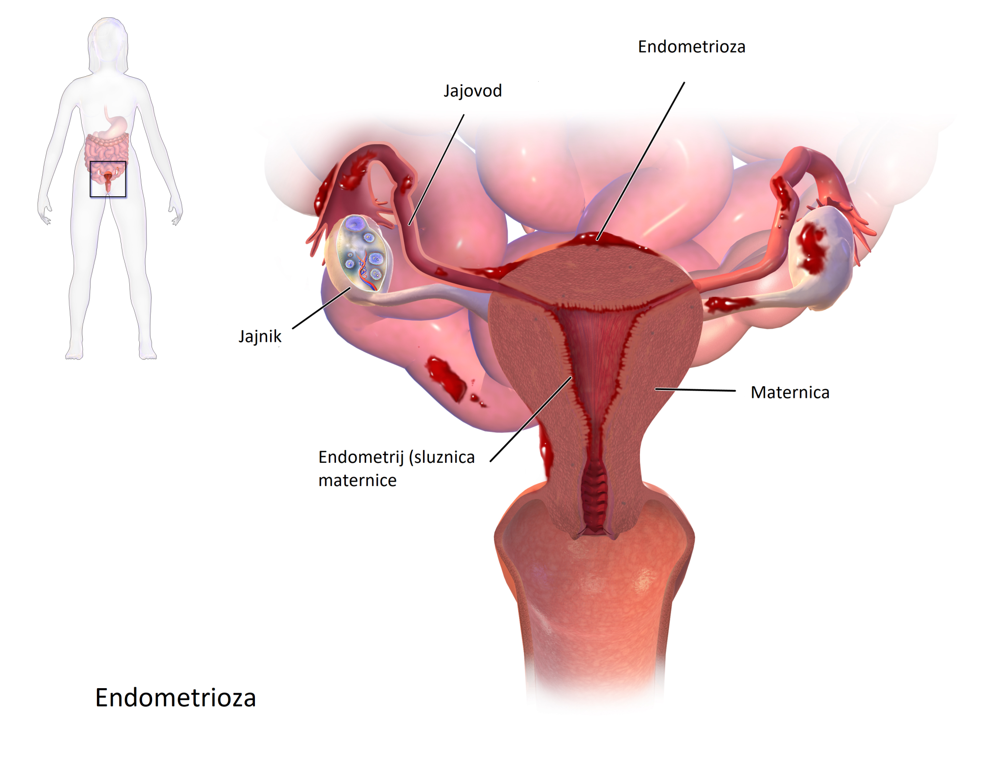 endometrioza