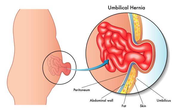 hernia