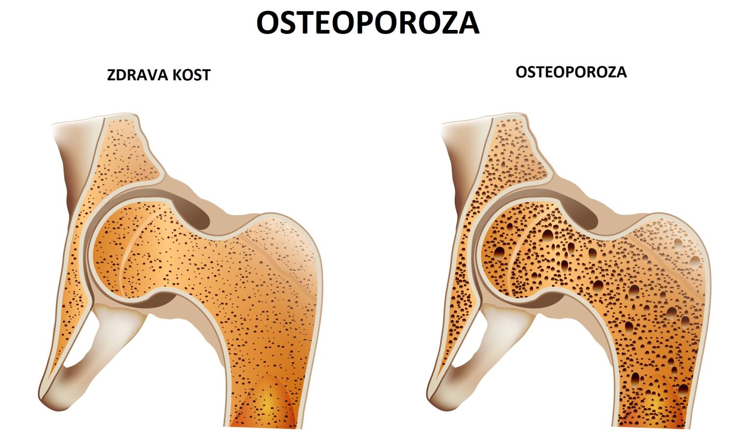 prehrana i liječenje artroze i osteoporoze
