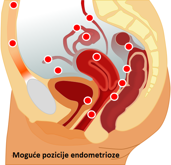 endometrioza