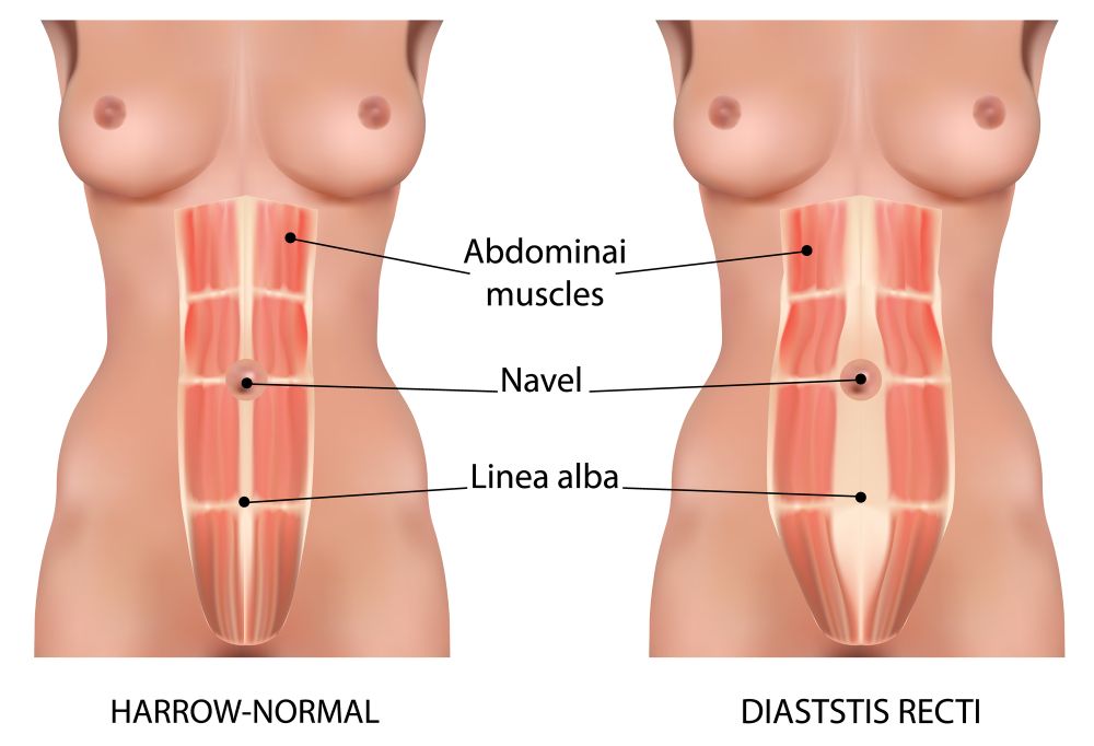 diastaza recti