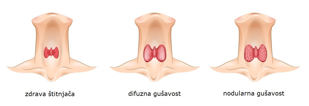 Prikaz štitnjače - gušavost