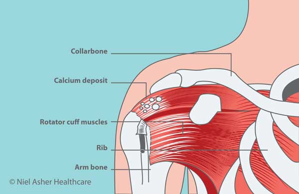 Kalcifikat u ramenu - vrste, simptomi i preporučene vježbe | Fitness.com.hr