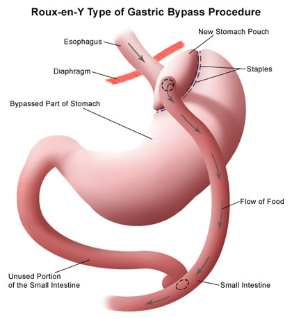 Roux-en-Y bypass