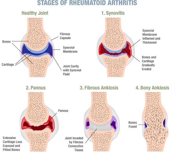 Reumatoidni artritis - liječenje prirodnim preparatima
