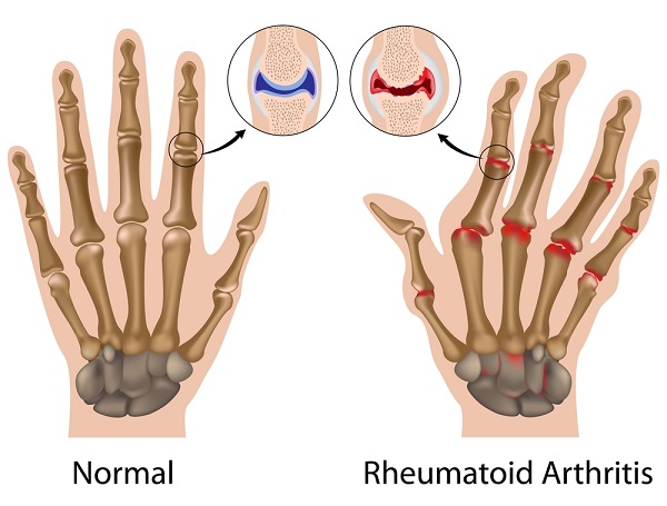 artritis ruke tablete liječenje