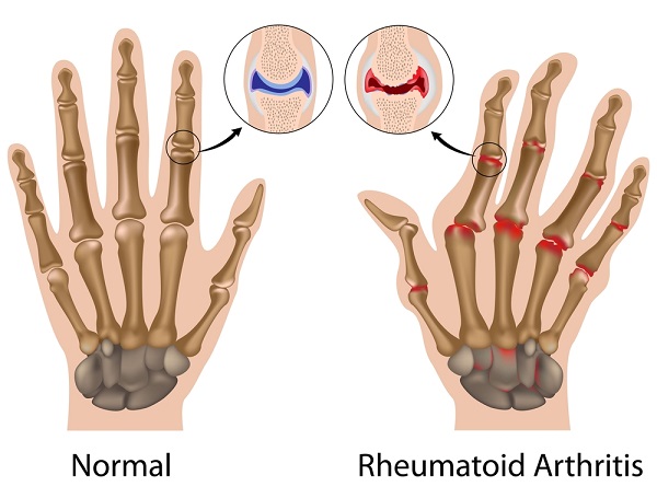 Reumatoidni artritis