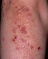 Dermatitis
