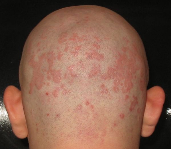 Dermatitis