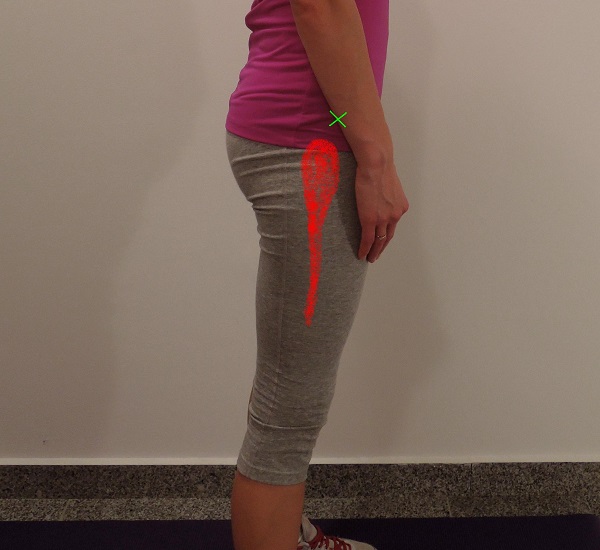 Bočna strana noge (Tensor fasciae latae)