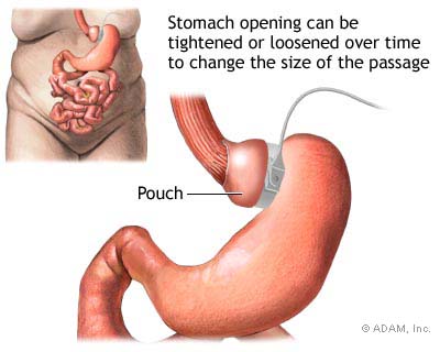 Gastric banding