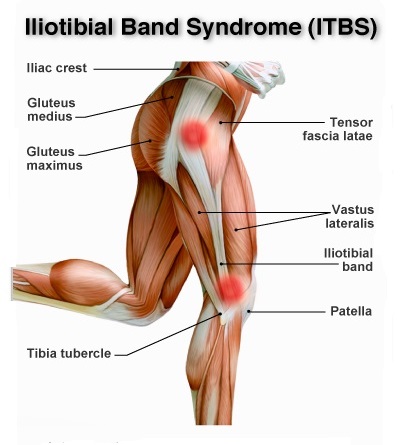 Trkačko koljeno (iliotibijalni sindrom): simptomi, uzrok boli, tretmani i oporavak | bloodlust-uk.com