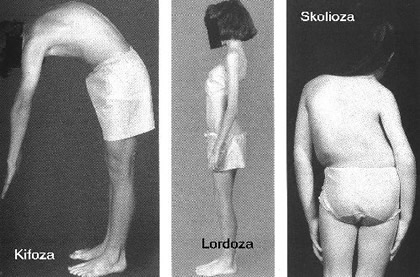 Kifoza, lordoza i skolioza