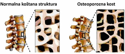 Osteoporoza
