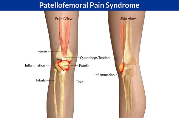 akutna bol s unutarnje strane koljena