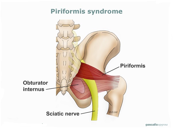 Piriformis sindrom