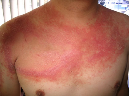 Psorijaza