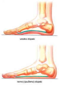 Ravno stopalo