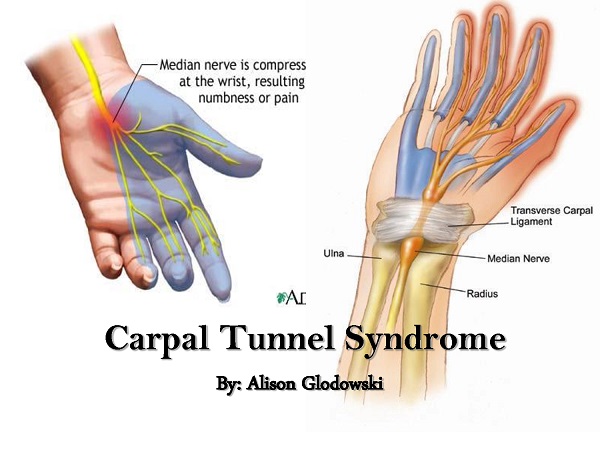 10 ranih simptoma sindroma karpalnog tunela, ali i kako ga prevenirati - interactstanbigelow.com