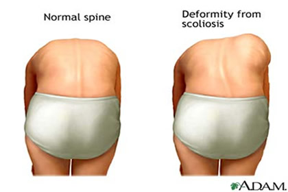 Skolioza