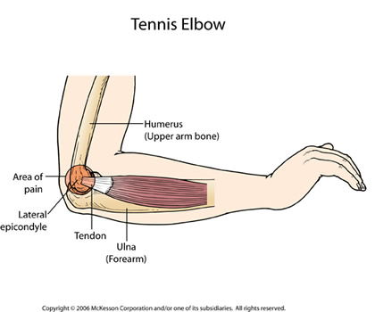 bolovi u zglobovima s klamidijskom infekcijom ublažiti bol u koljenu s artrozom