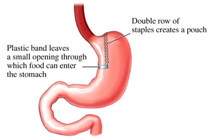 Vertical Banded Gastroplasty